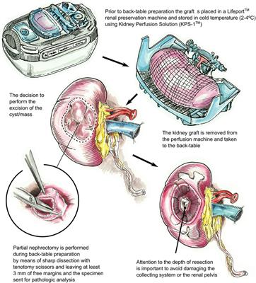 Optimizing the kidney donor pool: transplanting donor kidneys after partial nephrectomy of masses or cysts